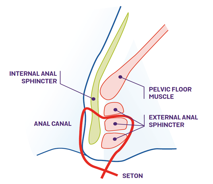 Loose Seton | Colorectal Unit
